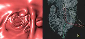 Gibt es bei eltern oder geschwistern fälle von darmkrebs, sollte eine. Die Radiologen Virtuelle Coloskopie 3d Die Radiologen