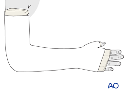 This ambra le roy medical products video demonstrates the proper technique for treating injuries to the hand, wrist and forearm with an elastic bandage and s. Long Arm Cast