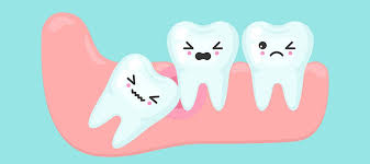 Having an infected wisdom tooth is an unpleasant condition and usually requires immediate attention. The 411 On Impacted Wisdom Teeth Cunning Dental Group