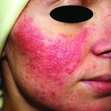Manche bereiten den lwenzahn mit einem besonderen hausrezept zusammen mit brennnesseln zur schmackhaften suppe, oder als beilage zu kr?uterquark Pdf Acne Rosacea