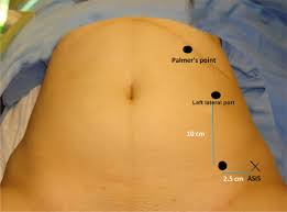Furthermore, major vascular structures are distant from palmer's point with the interposition of other organs. Left Lateral Port Safe Laparoscopic Port Entry In Previous Large Upper Abdomen Laparotomy Scar Journal Of Minimally Invasive Gynecology