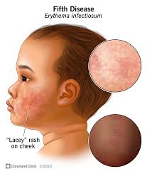 Image result for red rash face