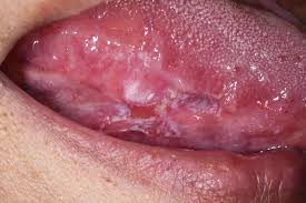 Image result for mouth ulcer on tongue)