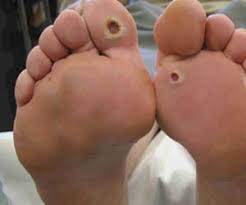 A red or dark patch. Foot Ulcer Causes Types Symptoms Treatment Prevention