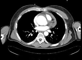 Ahmet can topçu pubg mobil. Management Of Traumatic Aortic And Splenic Rupture In A Patient With Ascending Aortic Aneurysm The Annals Of Thoracic Surgery