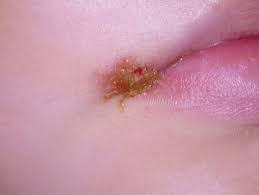 Für den lippenherpes ist das hsv 1 verantwortlich lippenherpes ist keine gefährliche infektionskrankheit. Herpes Labialis Einfach Schnell Und Nachhaltig Therapieren Zwp Online Das Nachrichtenportal Fur Die Dentalbranche