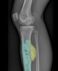 Other bones can be affected as well, such as the skull, pelvis, and. Malignant Bone Tumors Amboss