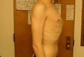 Sometimes the deformity isn't noticeable until after the adolescent growth spurt. Pectus Carinatum Pigeon Chest Symptoms Causes And Treatment