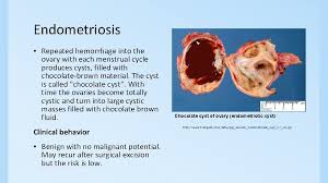 An overview of cochrane reviews. Polycystic Ovarian Disease And Endometriosis Pathology Ksu Riyadh