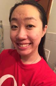 I Tried Apple Cider Vinegar For Acne To See If It Would Work