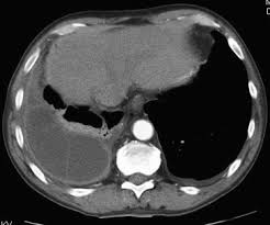 Treatment options for malignant pleural effusions are determined by several factors: Pleural Infection Sciencedirect