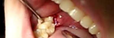 Wisdom teeth are third molars that usually appear between the ages of 17 and 25. Wisdom Teeth Tinnitus Reddit Tinnitus Finally Gone