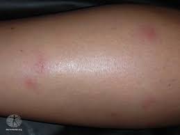 Image result for Cimex lectularius bites