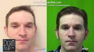 Fructose, and all kinds of sugar substitutes, like nutrasweet, aspartame, saccharin. Trivia All About Hair Transplantation