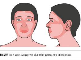 De NHG-standaard 'Verdachte huidafwijkingen'