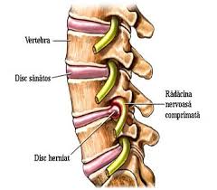 Programul williams este unul din cele mai cunoscute complexe de exerciții de kinetoterapie. Tratamentul Si Recuperarea In Hernia De Disc Discopatia Lombara Joasa Tratamentul Fizical Kinetic Si Recuperarea Medicala Bolile Oaselor