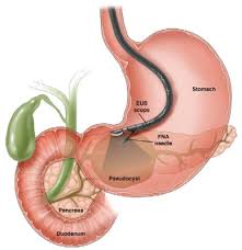 Endoscopic ultrasound EUS