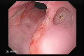 Infectious esophagitis (especially candida esophagitis) occasionally occurs in patients with diabetes mellitus or alcoholism, presumably because these diseases can impair immunity. Esophagitis El Atlas Gastrointestinal Gastrointestinalatlas Com