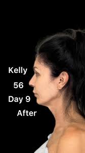 😍 I love watching Kelly bloom 🌸🌺🌷, 9 days postop, Kelly is 56, and has  been