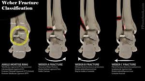 Injury, poisoning and certain other consequences of external causes. Ankle Fracture