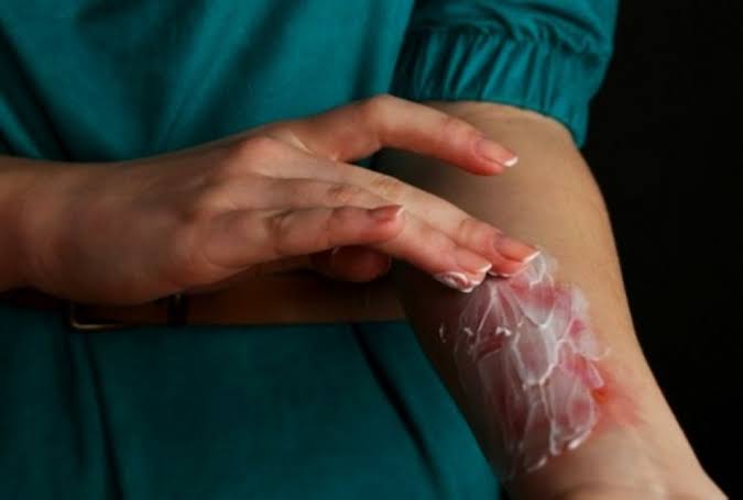 GCC bans the use of toothpaste for burns - Oman Observer
