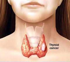 Treatment of thyroid cancer and hyperthyroidism in dogs depends on the size of the tumor, the amount of tissue involved, and the presence of metastasis (spread of cancer to other locations in the body). Dog Sniffs Out Thyroid Cancer In Us Health News Et Healthworld