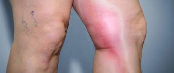 Are often found on valve flaps. Deep Vein Thrombosis Symptoms Dvt Causes Vascular Surgeon Texas