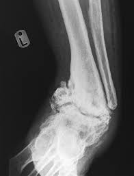 Charcot foot is a progressive condition that involves the gradual weakening of bones, joints, and soft tissues of the foot or ankle. Charcot Joint Ankle Radiology Case Radiopaedia Org