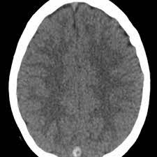 Cerebral venous thrombosis (cvt) is a thrombotic obstruction of the cerebral venous system that can lead to ischemic lesions (or hemorrhages) in the neuroimaging (mri or ct venography) of the cerebral veins and dural sinus is used to establish the diagnosis. Venous Sinus Thrombosis How To Avoid Underdiagnosis On Non Enhanced Head Ct Eurorad