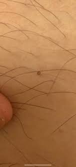 Ingrown hairs are capable of developing under skin on any area of your body, especially the face and legs, but they can be particularly annoying when they plant themselves in your armpit. An Ingrown Hair On My Arm Mildlyinteresting