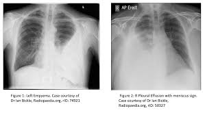 Image result for Parapneumonic Effusion