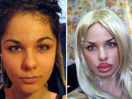 The number of people getting cosmetic procedures has risen steadily over the past five years and there are several reasons why. Plastic Surgery Gone Wrong Plastic Surgery Fail Plastic Surgery Gone Wrong Bad Plastic Surgeries