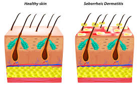 Find out why itch matters in treating hair loss. What Can Be Done To Treat An Itchy Scalp Elithairtransplant
