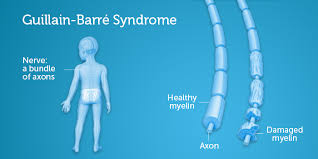 Weakness and tingling in your extremities are typically the first symptoms.these experiences can rapidly spread, ultimately disabling your whole body. Guillain Barre Syndrome Boston Children S Hospital