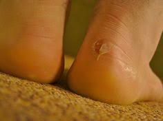 Ayaktaki Su Toplamasina Dogal Tedaviler Sagliga Bir Adim Blister Remedies How To Treat Blisters How To Heal Blisters