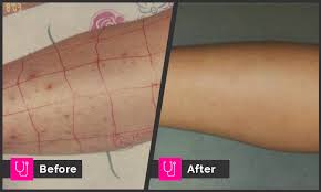 Folliculitis, also known as ingrown hairs or razor bumps, is caused by infective bacteria in the follicle. Laser Hair Removal Archives Page 2 Of 2 Main Line For Laser Surgery In Ardmore Pa
