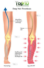 If this happens inside a person's body, including their leg, it can cause severe problems. Blood Clots Deep Vein Thrombosis D V T And Pulmonary Embolism