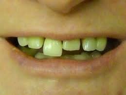 Browse great information and extensive results. Dentures Partial Dentures Dentist Livonia Mi Ann Arbor Mi