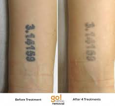 The Size Of The Tattoo Won T Dictate How Quickly It S Removed This Tattoo Is Smaller Than A Business Card And Will Tattoos Tattoo Removal Laser Tattoo Removal