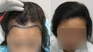 You can increase the length or volume of your hair by simply attaching either artificial or human hair to the ends of your own hair. Can Hair Extensions Lead To Hair Loss Usa Dynasty Goddess Hair