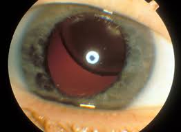 Image result for Red Reflex