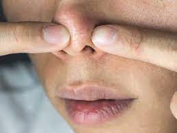 About The White Stuff That Comes Out When You Squeeze Your Nose Pores