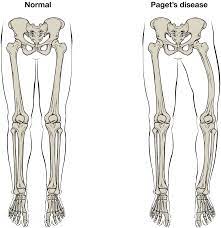 The knee joint is the largest joint in the body and is primarily a hinge joint, although. Bone Structure Anatomy And Physiology