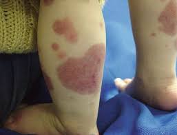 Hsp may be a response to a viral or bacterial infection, but ultimately there is no consensus on the cause. Vasculitis Henoch Schonlein Purpura Springerlink