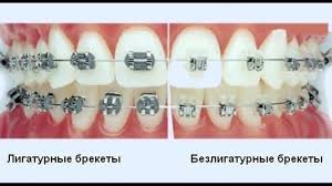 Металлические брекеты — стандартные стальные компоненты и стальная лигатура, которые в новом исполнении уменьшились в размерах, сократив неудобства, доставляемые пользователю. Metallicheskie Brekety Cena S Ustanovkoj Foto Ustanovlennyh Metallicheskih Breketov Vidy