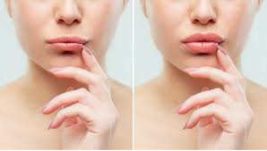 This week im giving you all a lip filler before and after ! Needleless Lip Fillers Lip Fillers Without Needles Dr Michele Green M D