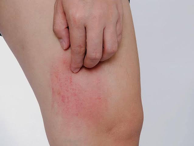 Ngứa kèm sưng vùng giữa bắp đùi phải là dấu hiệu bệnh gì? | Vinmec