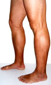Actinic keratosis is scaly brown skin discoloration on lower legs on the skin that arise as a result of prolonged exposure to the sun. Chronic Venous Insufficiency Wikipedia