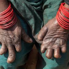 Image result for Leprosy