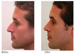 The entire procedure was filmed for plastic on mixed makeup, and a ton of people left comments. Nose Job Specialist Richmond How Much Does Nose Job Surgery Cost